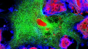 Neuroblastoma cells: nuclei are stained in red, microfilaments are in green and in blue | Feature | Epigenetic Subtypes Discovered in Neuroblastoma Super Enhancer Profiles