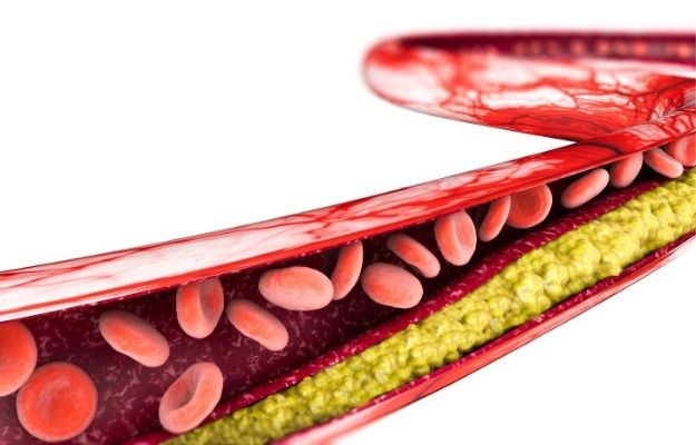 Atherosclerosis | Kefir Peptides Ease High-Fat Diet-Induced Atherosclerosis