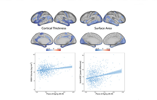 Image of brain aging | DunedinPoAm Algorithm: TruDiagnostic's Accurate Method in Predicting Biological Aging
