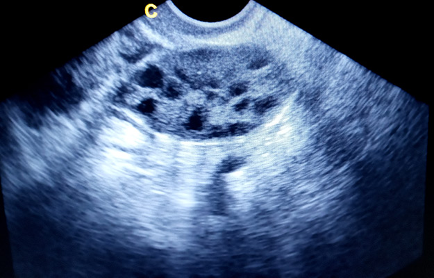 X-ray image of polycystic ovary | Can Polycystic Ovary Syndrome Be Passed Down Epigenetically?