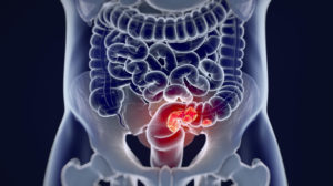 colorectal-cancer-concept------------Discovery-of-…w-Drugs-In-Colorectal-Cancer-Treatment | feature | Discovery of New Drugs Has Opened a Therapeutic Window In Colorectal Cancer Treatment